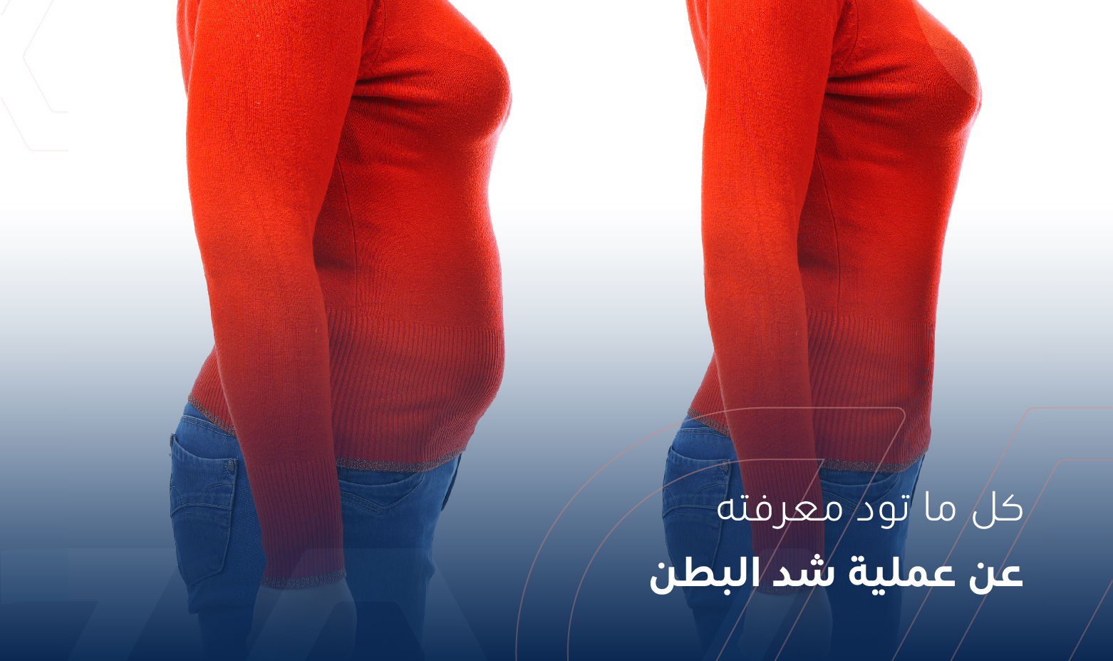 كل ما تود معرفته عن عملية شد البطن - دكتور إيهاب نصار